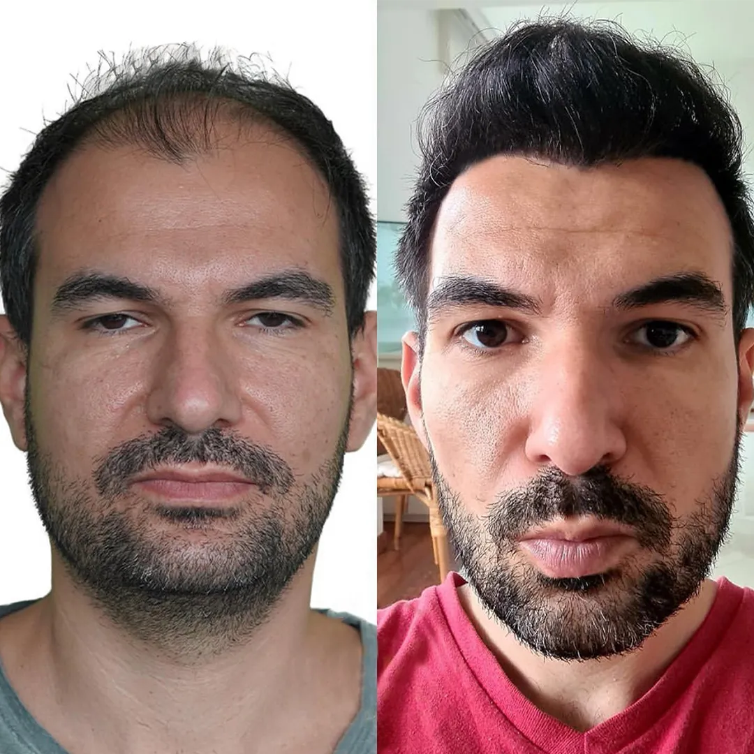 Hair in Mexico patient before and after a hair transplant