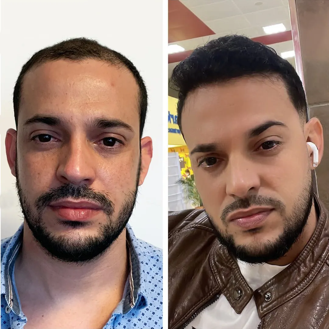 Hair in Mexico patient before and after a hair transplant at the front hairline