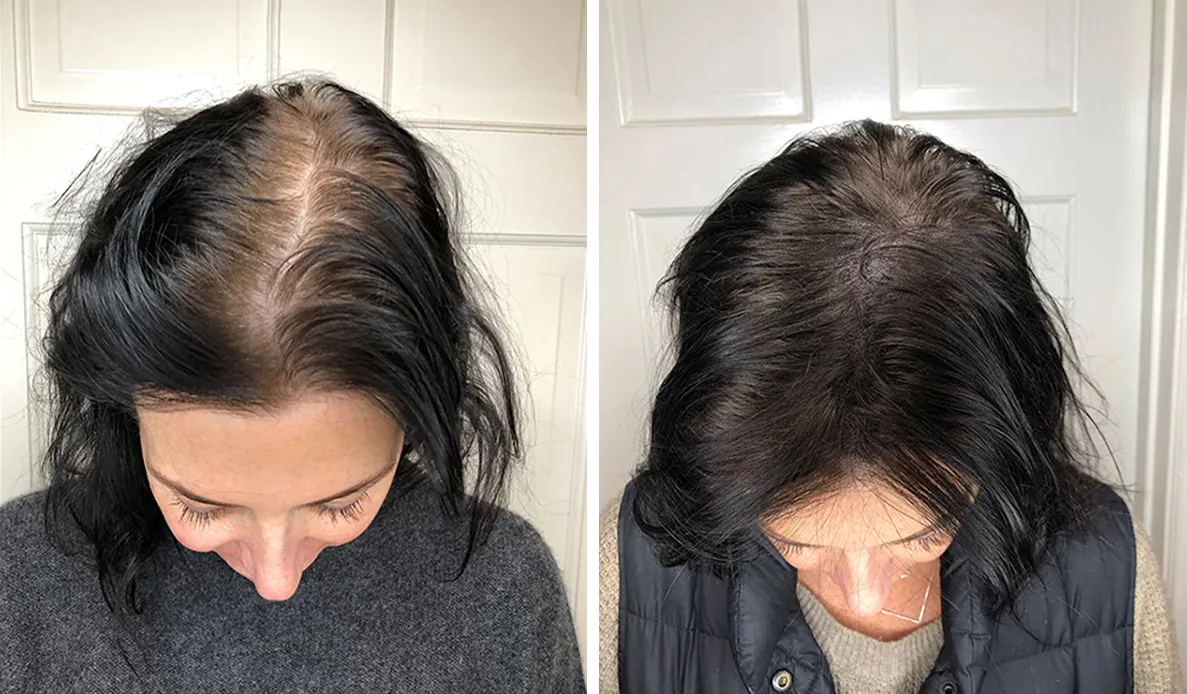 Female patient before and after a hair transplant